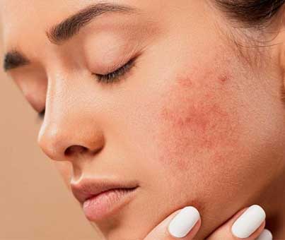 Acne and acne scar treatment with laser