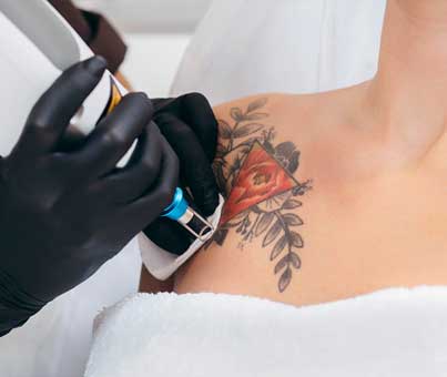 Tattoo removal with laser